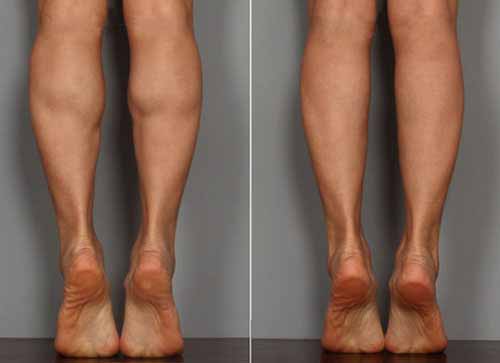 　　肌肉型小腿的瘦腿方案