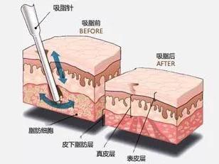 全身抽脂减肥多少钱 抽脂减肥有哪些注意事项